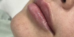 aumento de labios