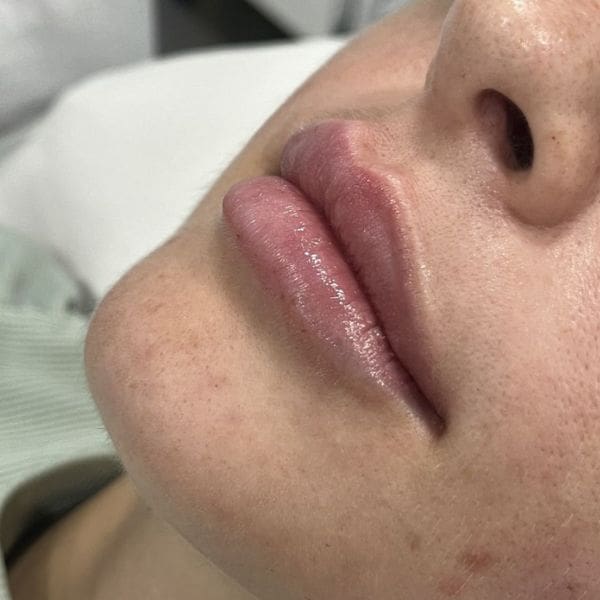 después resultado aumento de labios con ácido hialurónico