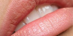 Ácido Hialurónico para hidratar los labios