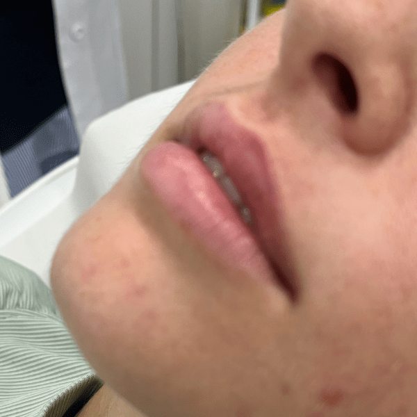 aumento de labios