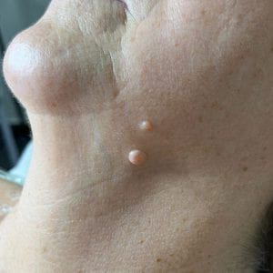 Eliminación de Verrugas y Lunares Sin Dolor