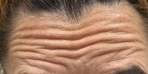 Mejorar y prevenir las arrugas con Botox