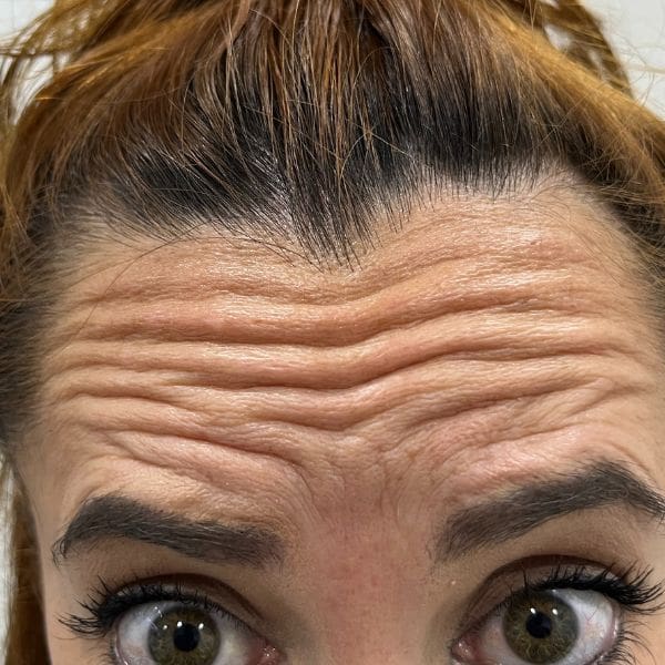 Mejorar y prevenir las arrugas con Botox