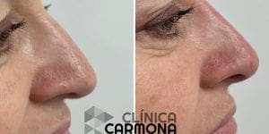 Rinomodelación Sin Cirugía o Rinoplastia
