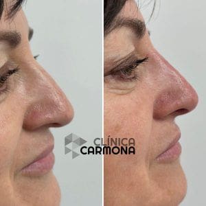 Rinomodelación Sin Cirugía o Rinoplastia