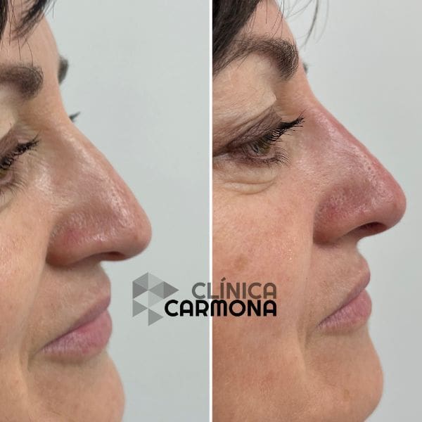 Rinomodelación Sin Cirugía o Rinoplastia