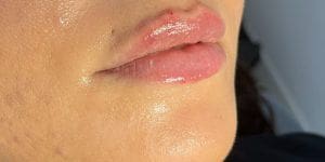 aumento de labios en Totana