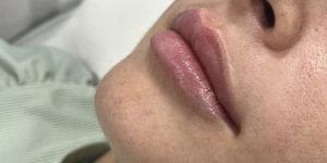 aumento de labios con ácido hialurónico en Totana