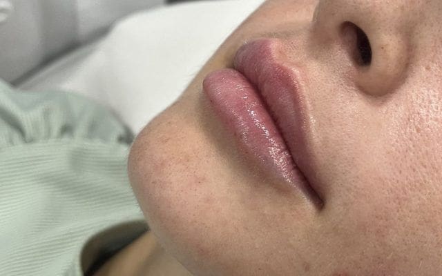 aumento de labios con ácido hialurónico en Totana