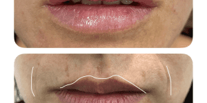 Resultado del tratamiento de aumento de labios