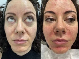 Tratamiento full face con ácido hialurónico