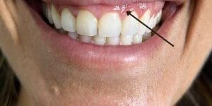 Sonrisa gingival estética