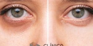 ojeras