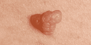 Verrugas y Cambios Hormonales