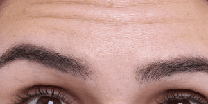botox