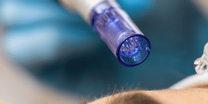 dermapen facial