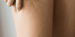 Cómo Combatir la Celulitis en Totana