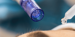 Dermapen con Exoxomas