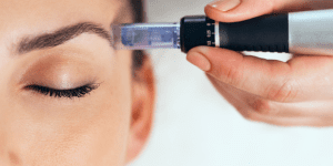 Dermapen con Exosomas y Péptidos