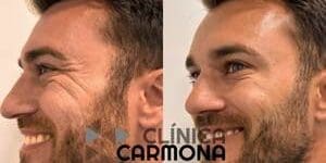 botox