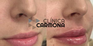 aumento de labios Totana